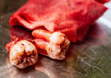 Root Canal Treatment