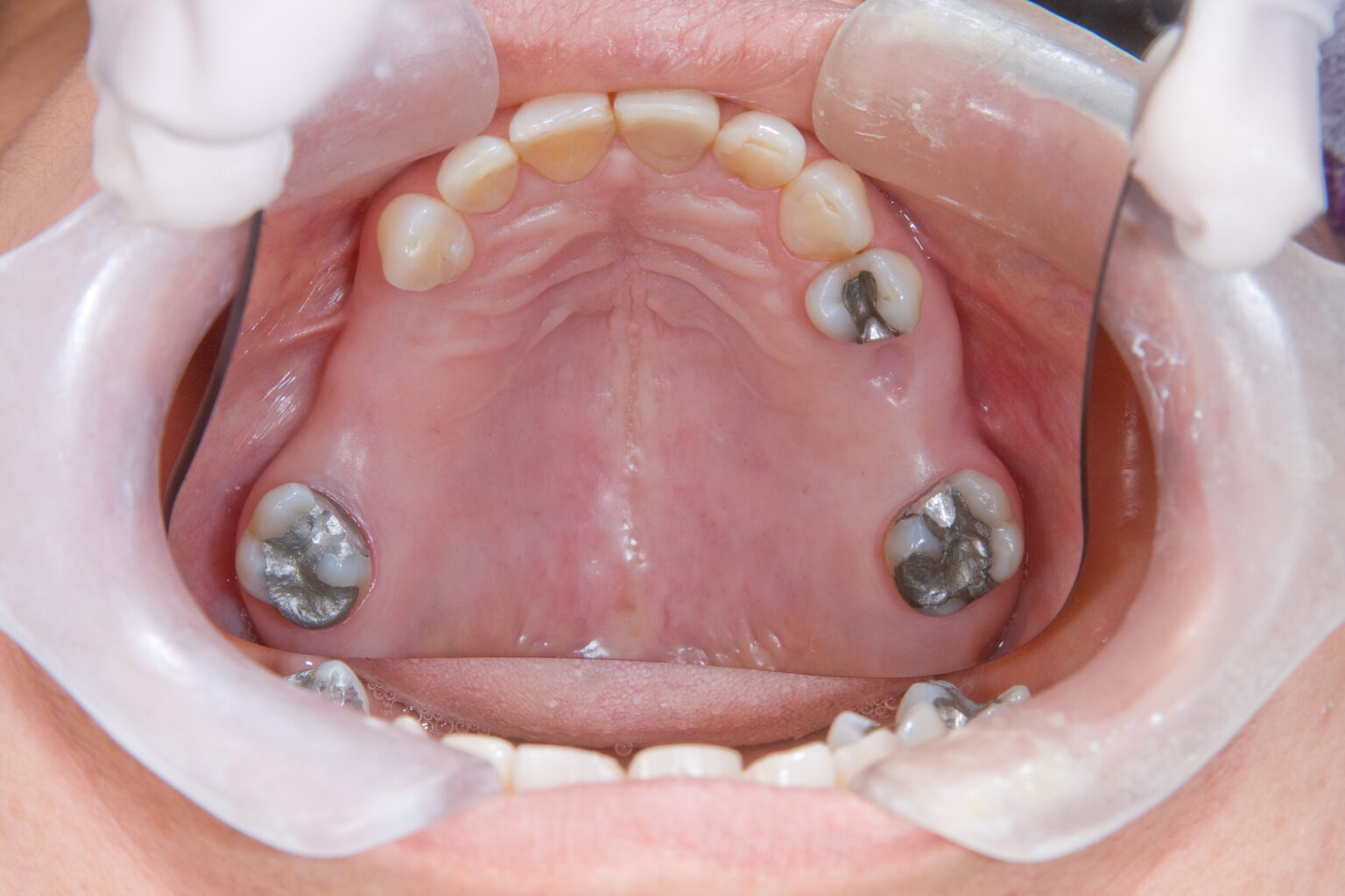 Dental Fillings