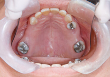 Dental Fillings