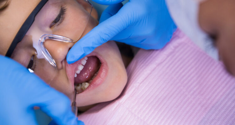 Dental Sealants