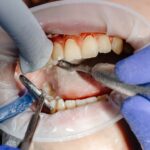 Dental felling