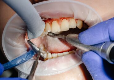 Dental felling
