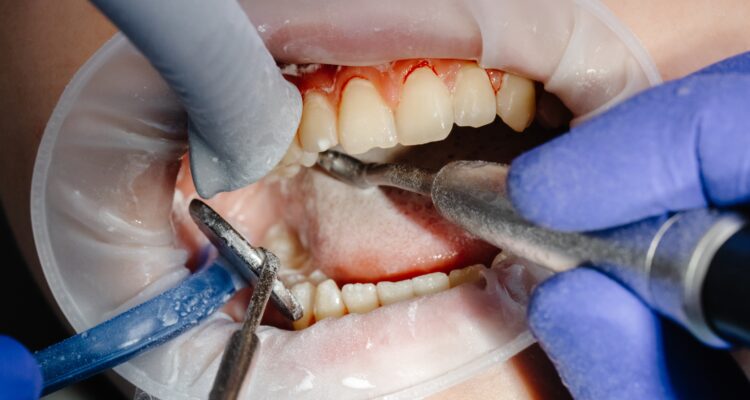 Dental felling