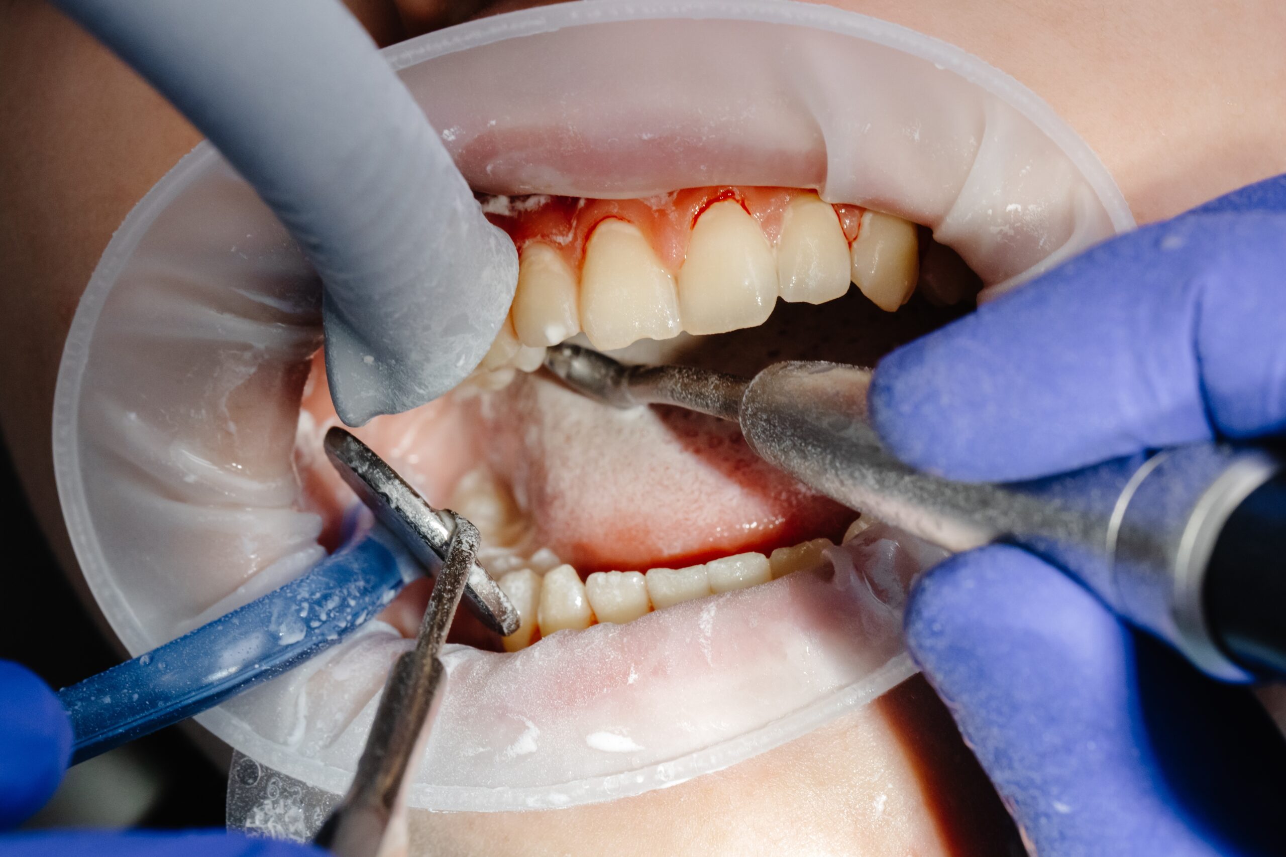 Dental felling
